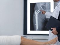 Trafik Kazasında Femur Kırığı Engel Oranı ve Tazminat