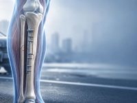 Trafik Kazasında Tibia ve Fibula Kırığı Engel Oranı ve Tazminat